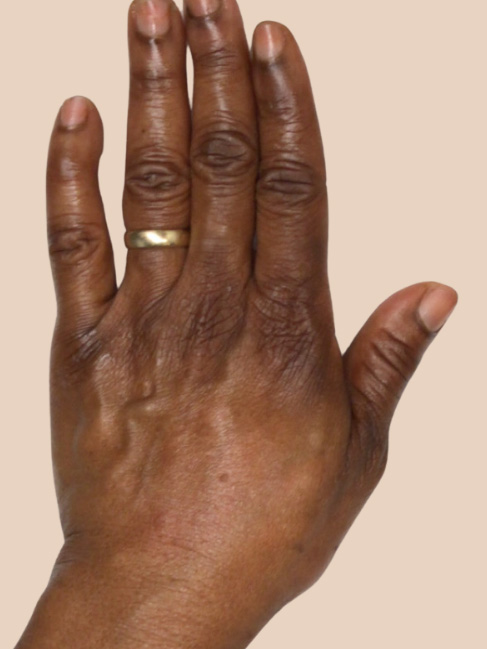 hand rejuvenation with fillers new york city